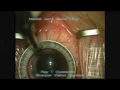 Ray Oyakawa, MD Demonstrates Pachymetry Adjusted AK