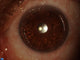 Ahmed Slit Lamp Astigmatic Keratotomy
