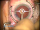 (2/2) Astigmatism Management for Modern Lens-Based Surgery (Part 2/2)