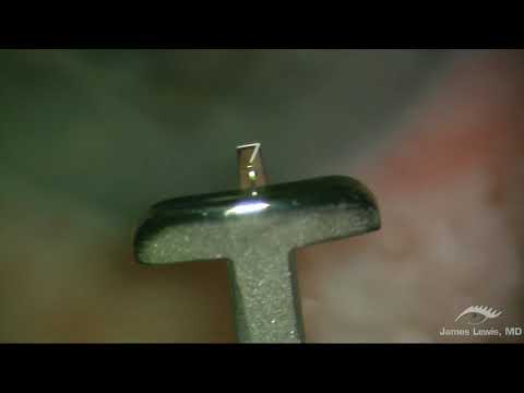 Limbal Relaxing Incisions - Blade Comparisons